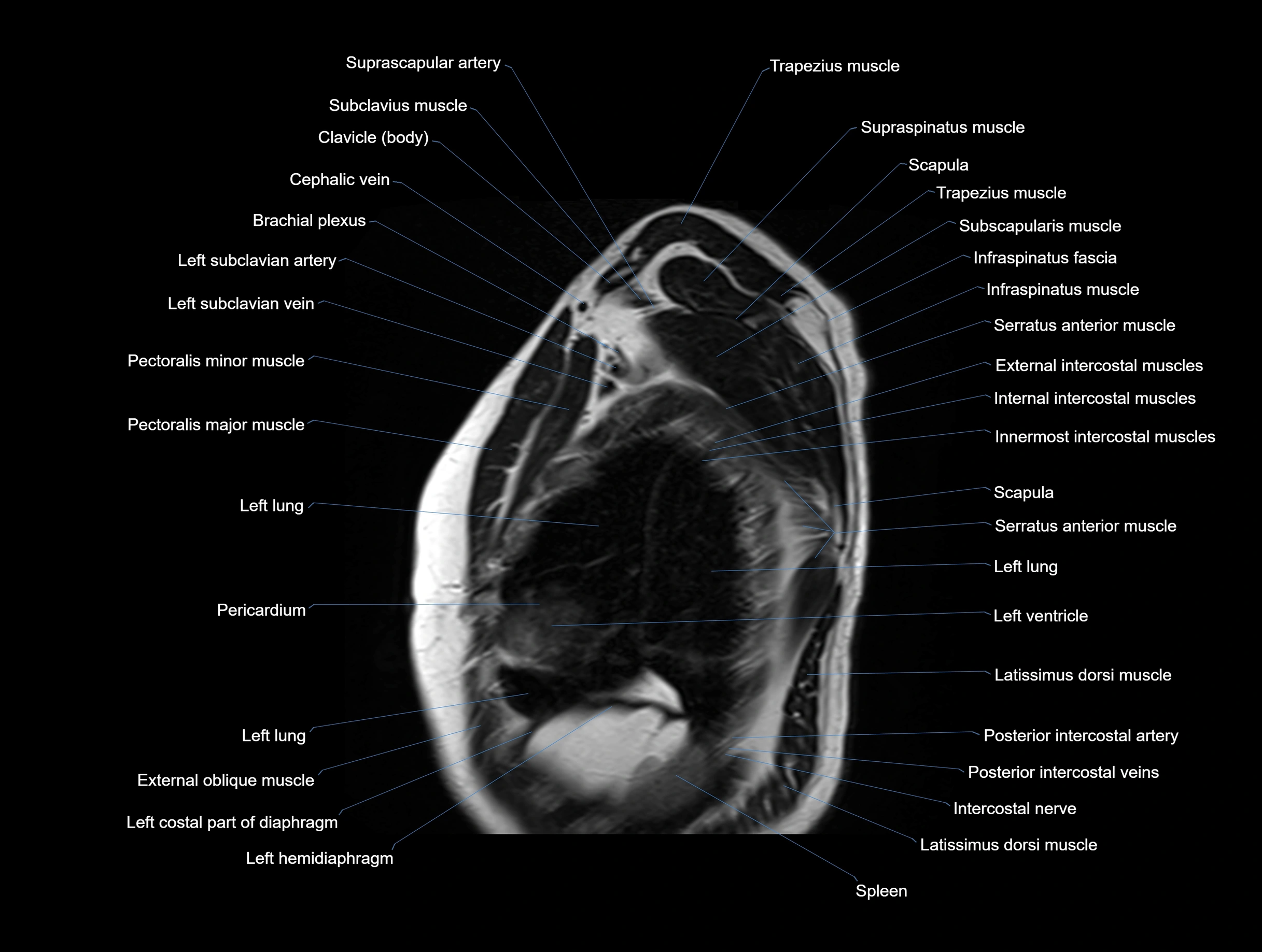 MRI chest (thorax) coronal  cross sectional anatomy 3T radiology  image-img-00001-00032.webp